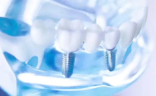 インプラント治療がしたい