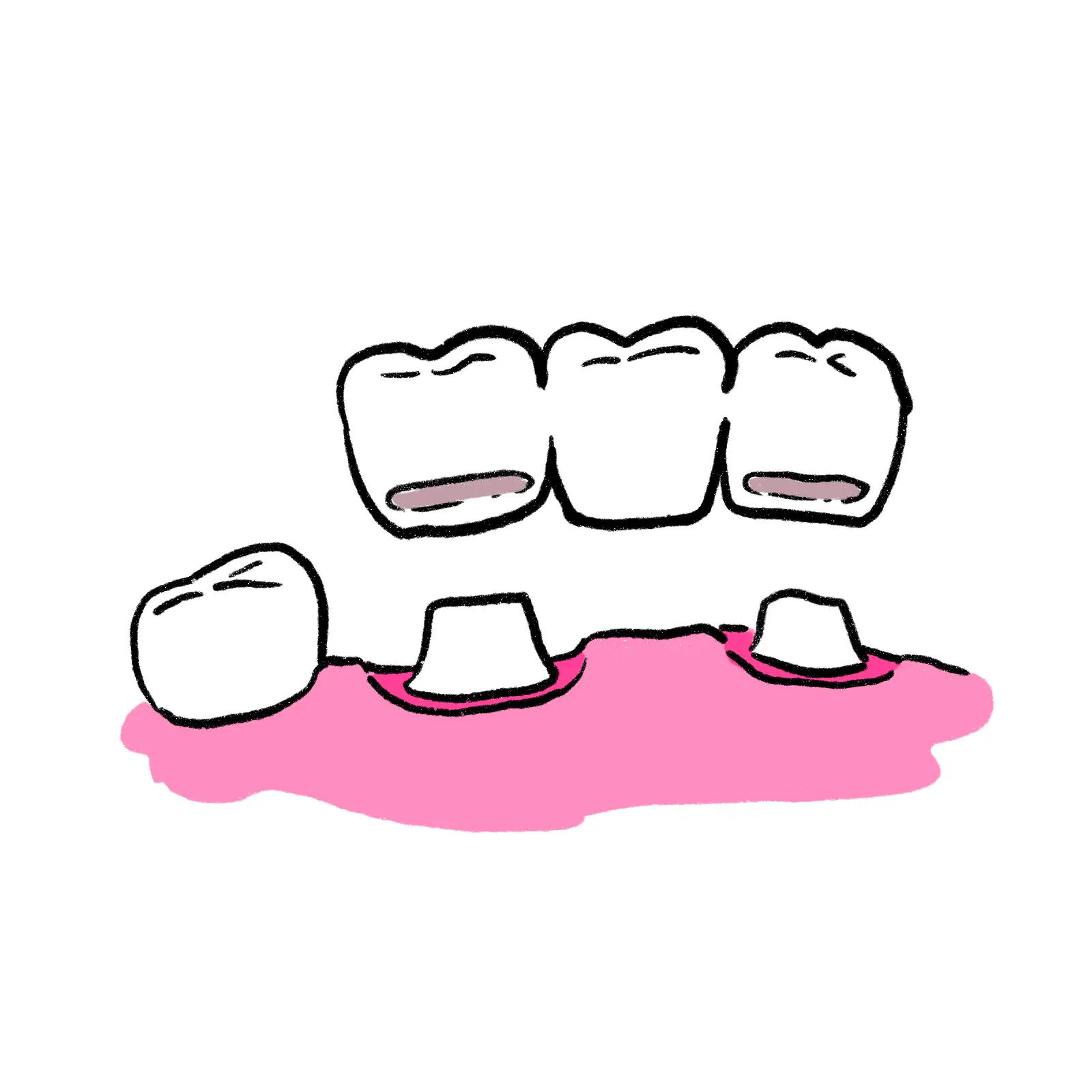 ブリッジ治療とは