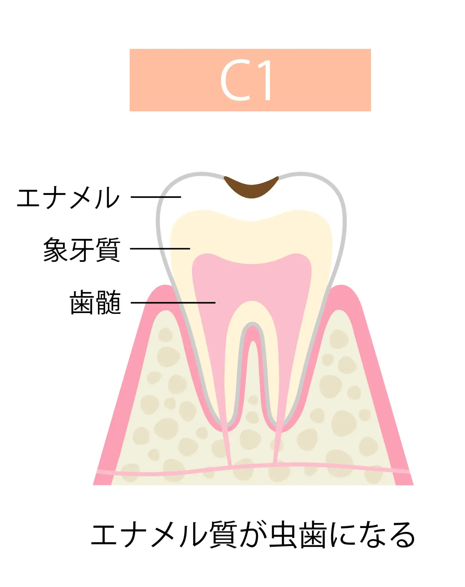 C1 エナメル質のむし歯