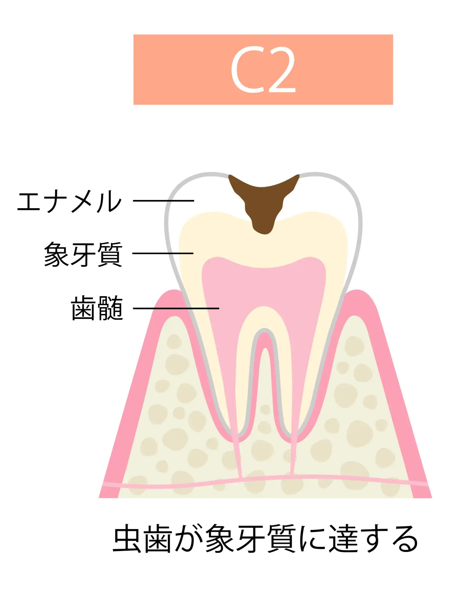 C2 象牙質のむし歯