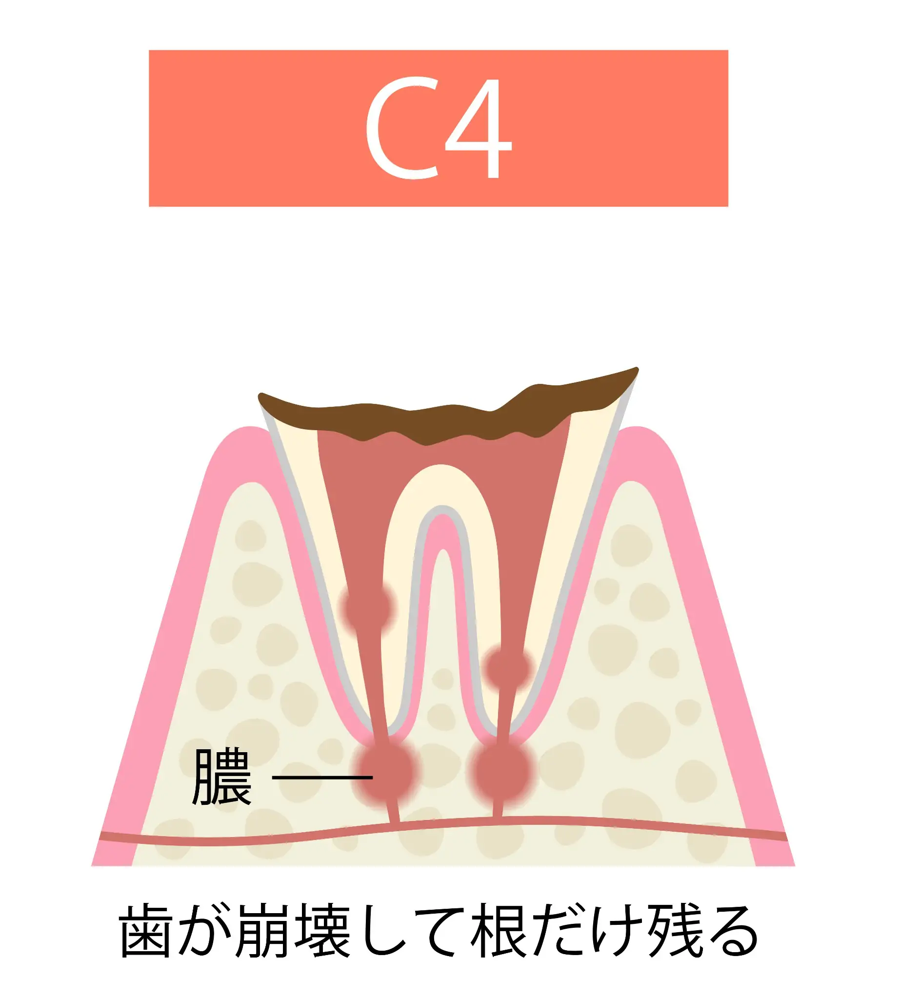 C4 歯の根だけが残った状態