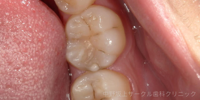 C1のエナメル質の虫歯