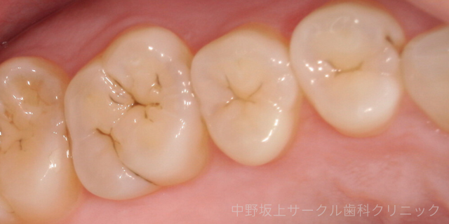 C1の虫歯の写真
