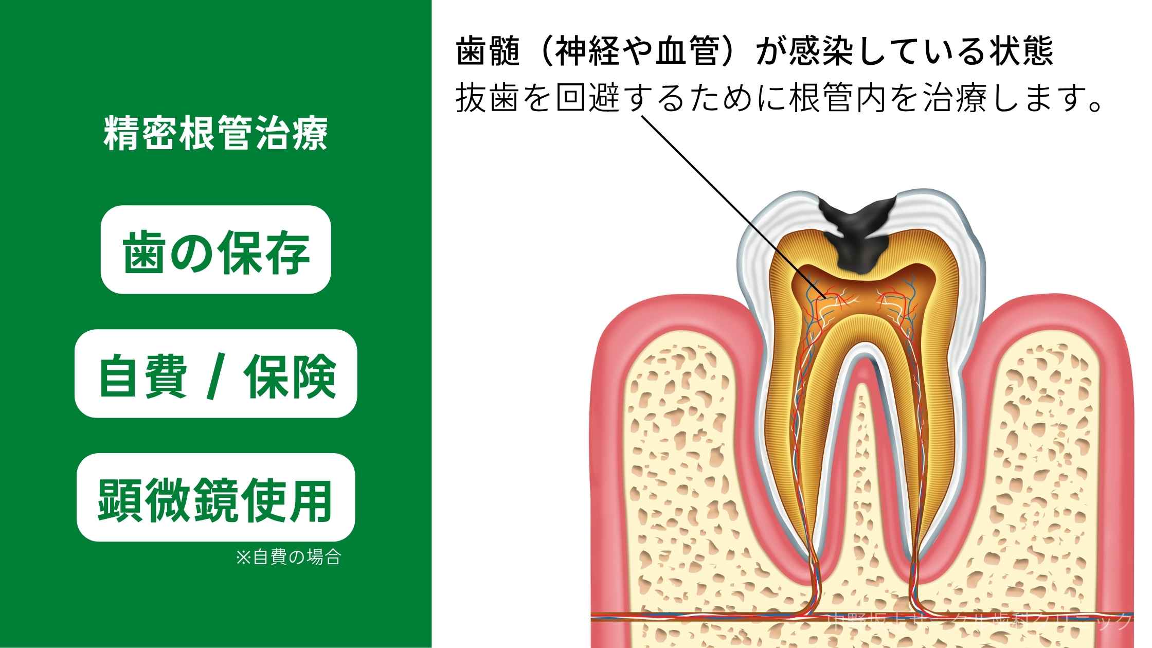 精密根管治療