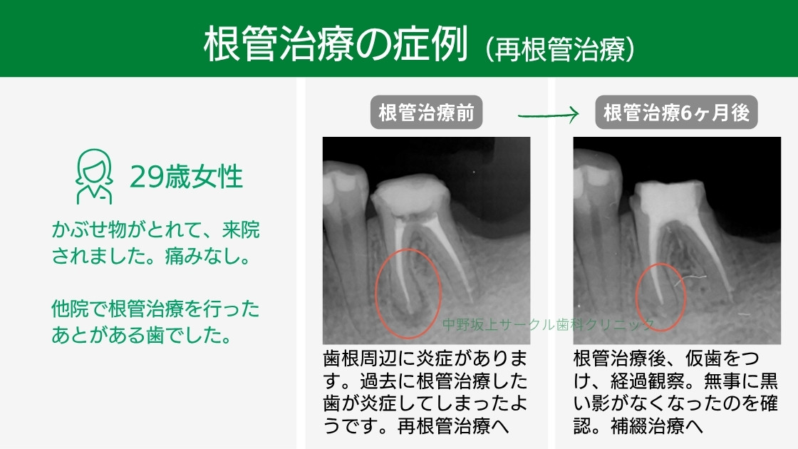 再根管治療前後のレントゲン写真